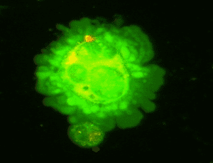 NDV infected glioma cells